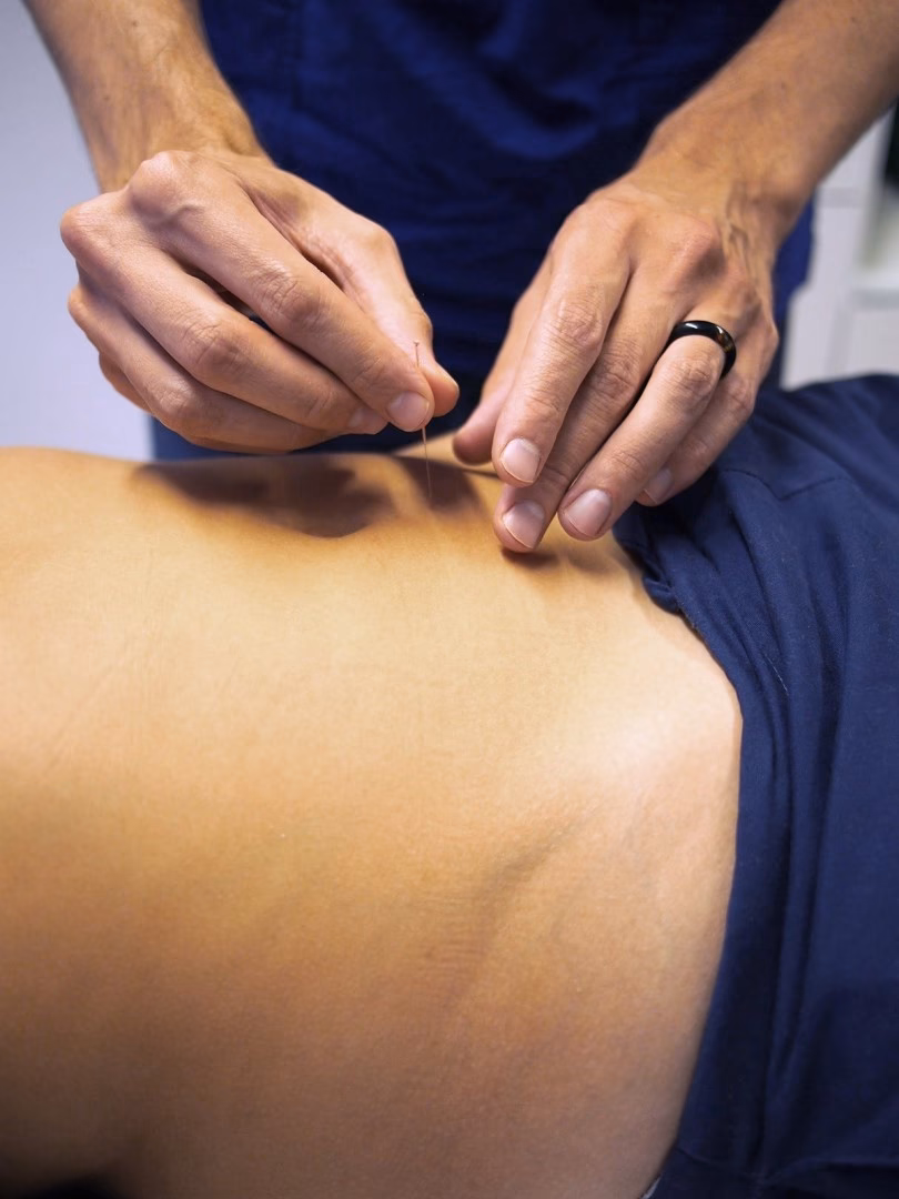 What is pre-menstrual tension (PMT)?