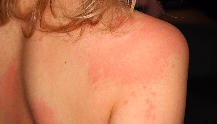 Can drinking alcohol cause a food allergy?