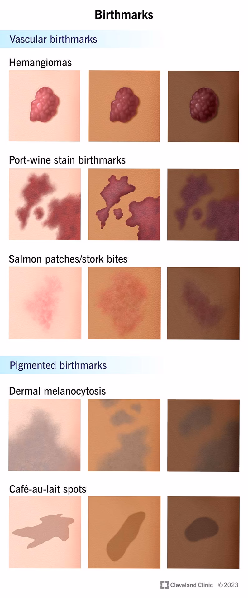 When should a birthmark be referred for an urgent ophthalmology opinion?