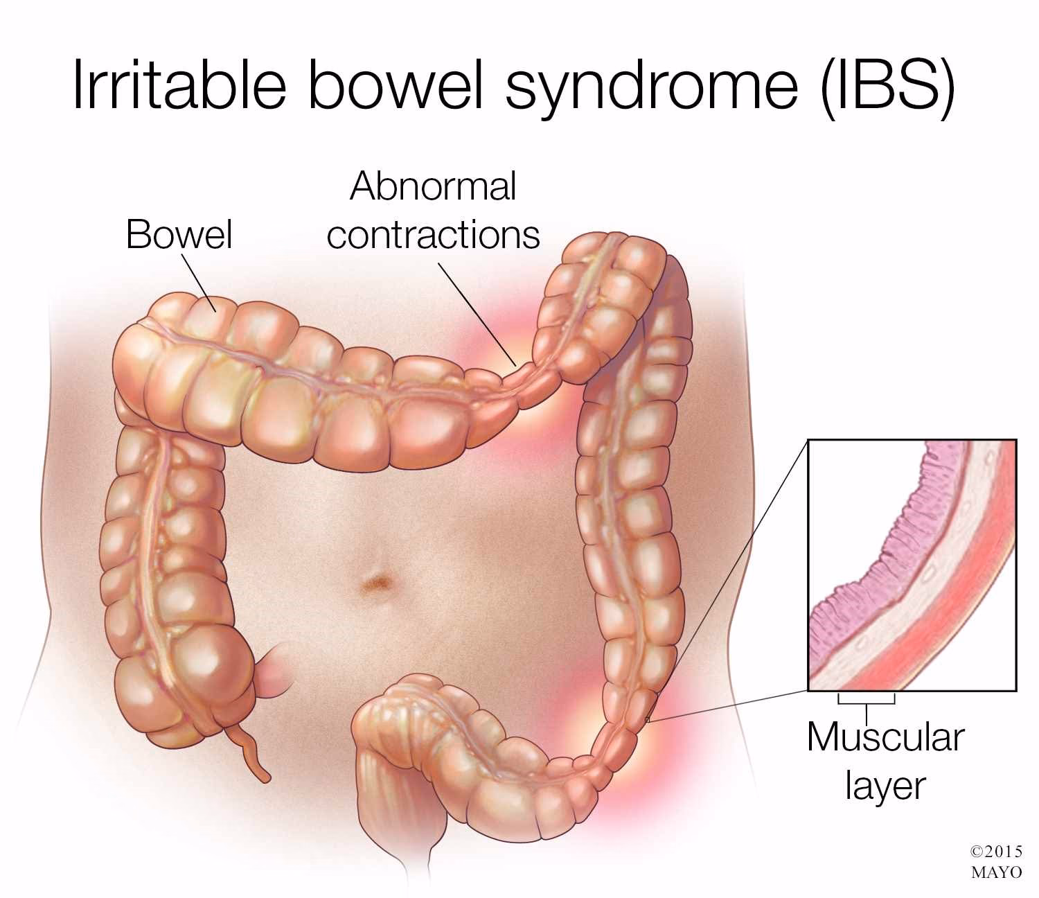 Does Constella treat irritable bowel syndrome (IBS) with constipation?