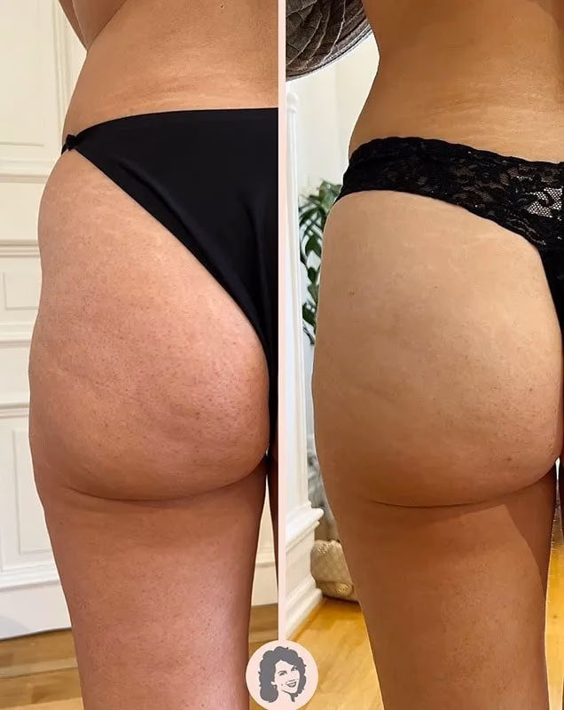 Do DermaPen treatments really work?