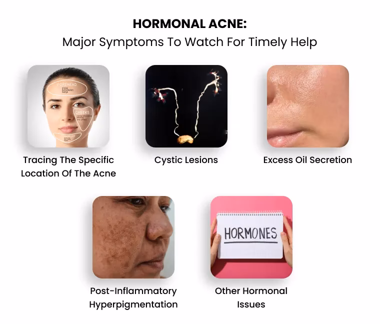 What causes oily skin?