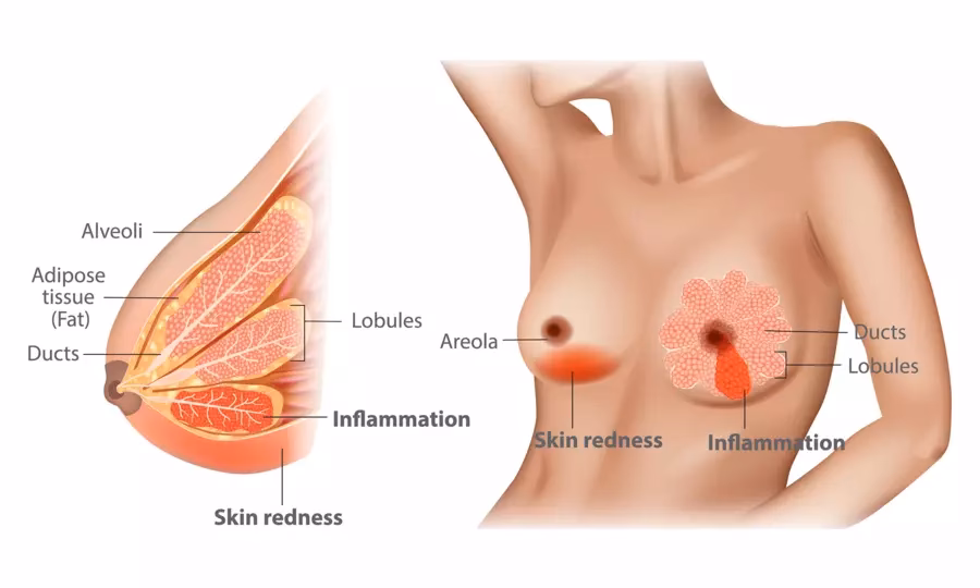 Why are my breasts sore after a menstrual period?