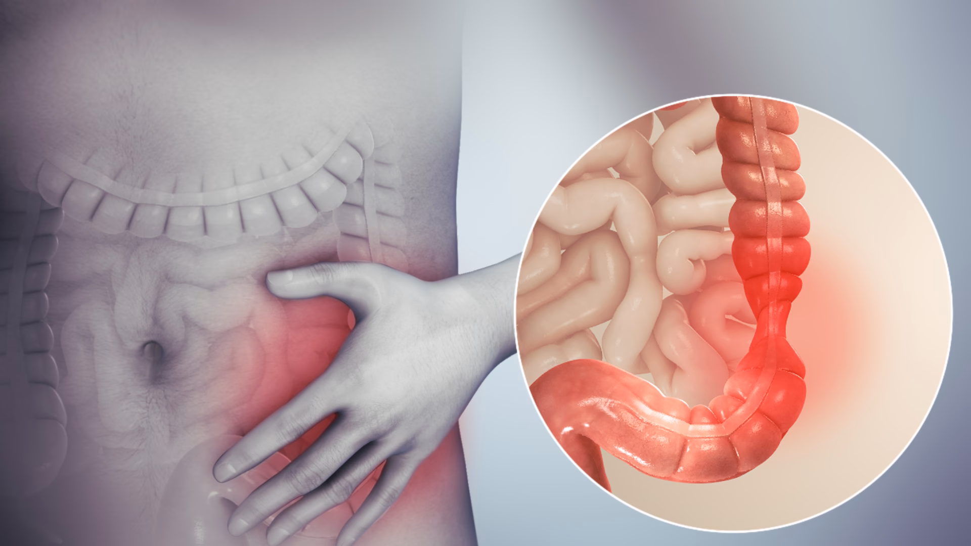 How is irritable bowel syndrome (IBS) treated?