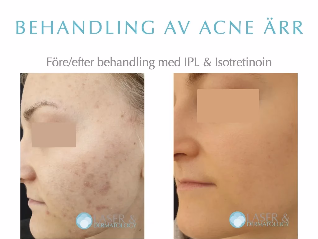 Do you need a prescription for acne?