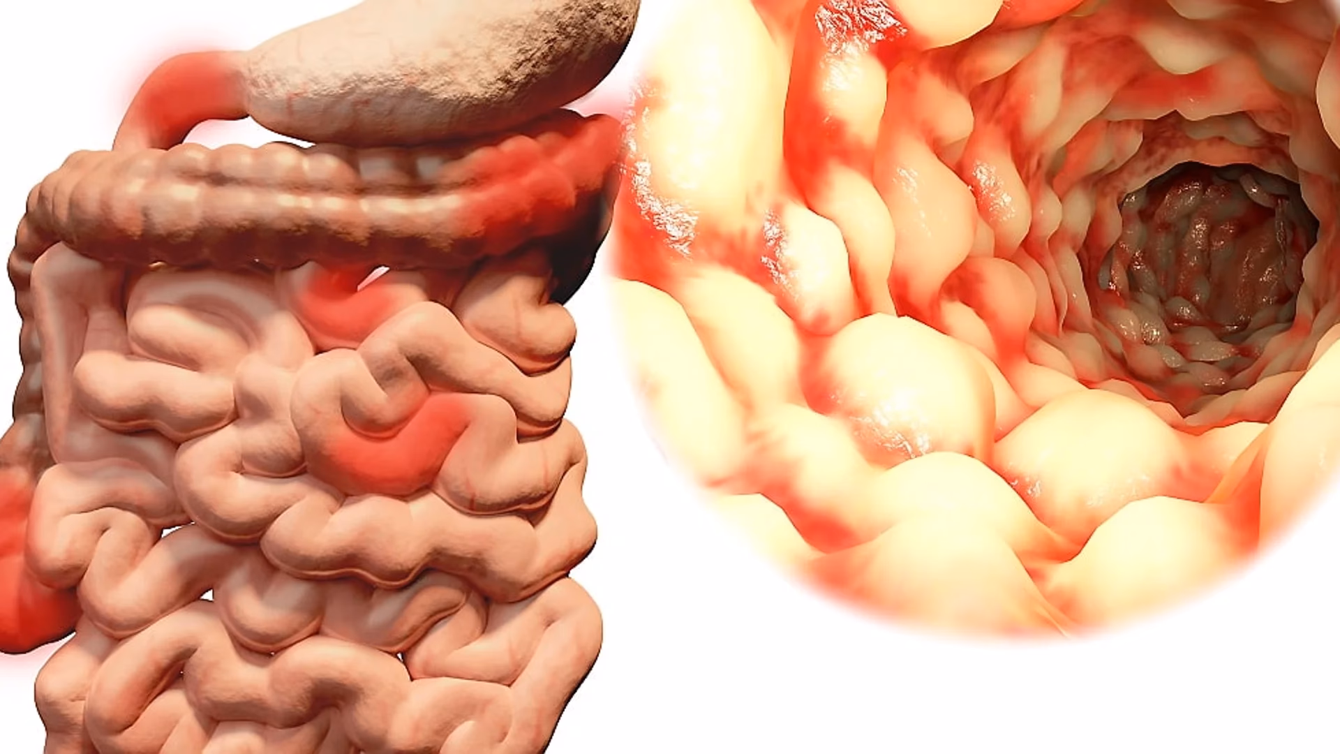Vilka antibiotika används vid Crohns sjukdom?