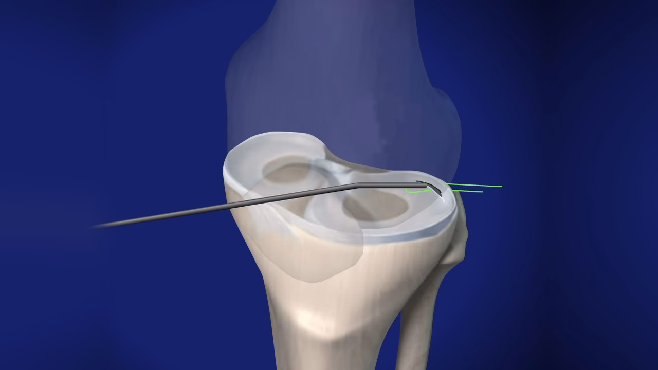 Can a meniscus be torn?