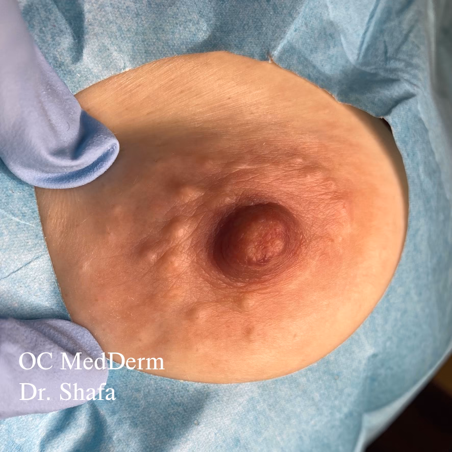 Why are my Montgomery tubercles getting bigger and sticking out more?