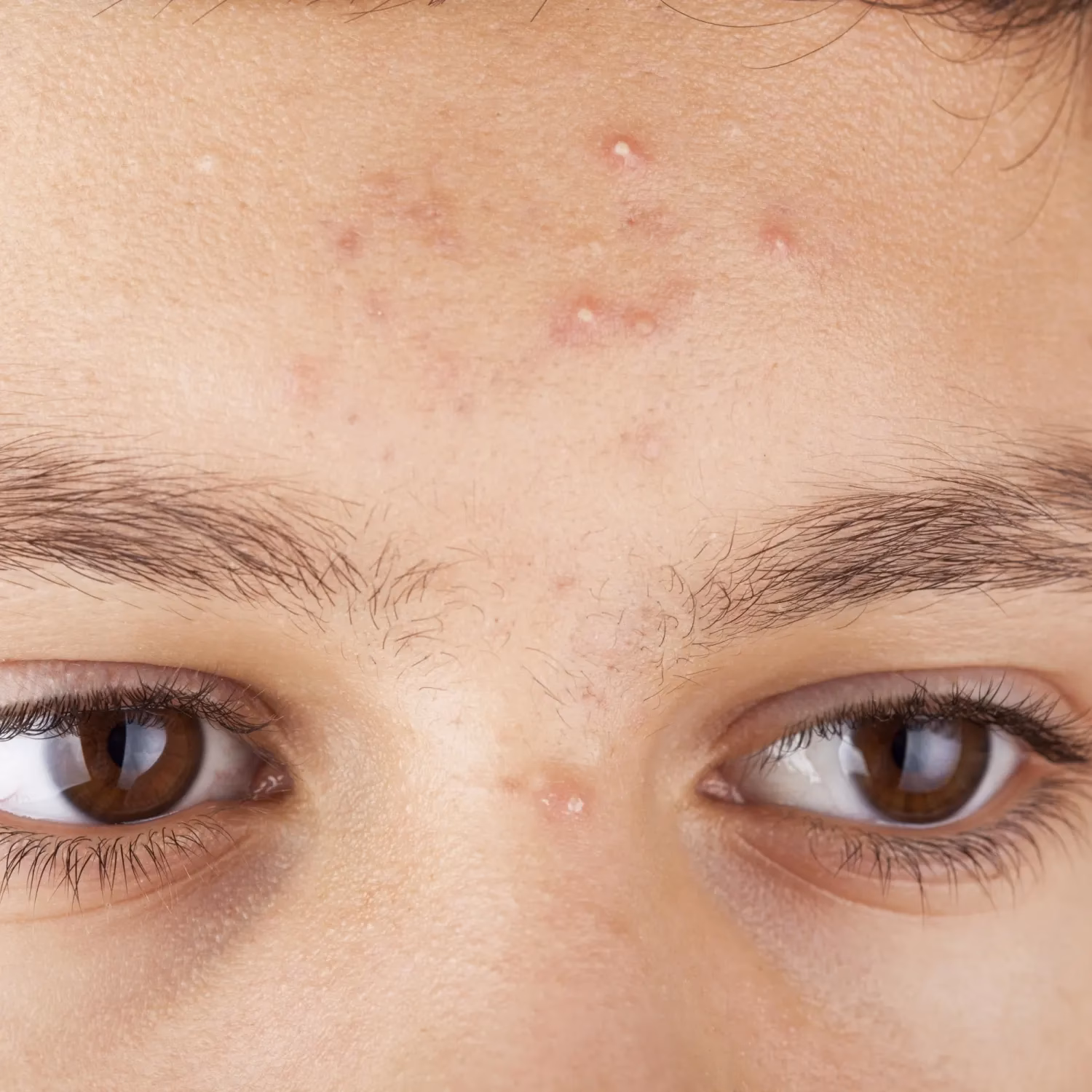 What is acne & why is it a problem?