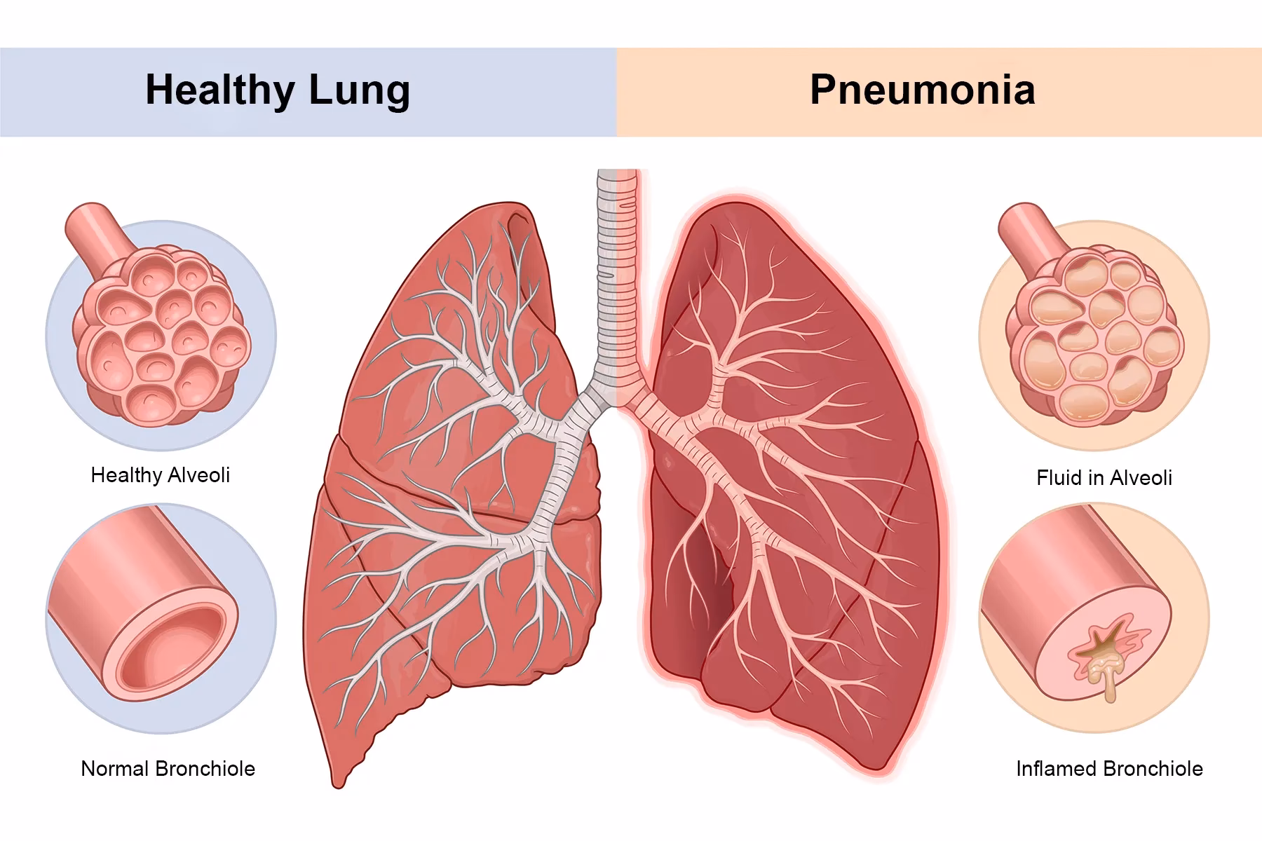 What is aspiration pneumonia?