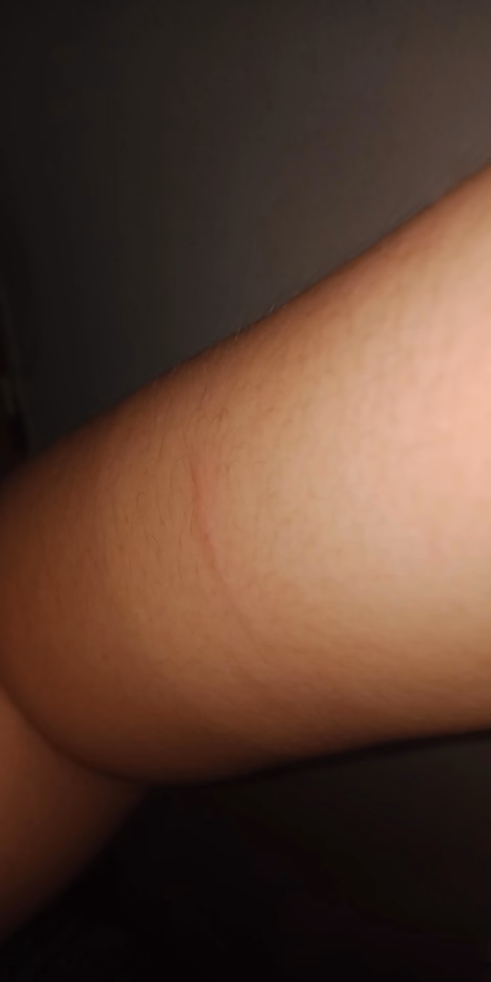 Is a scratch from a dog a bacterial infection?