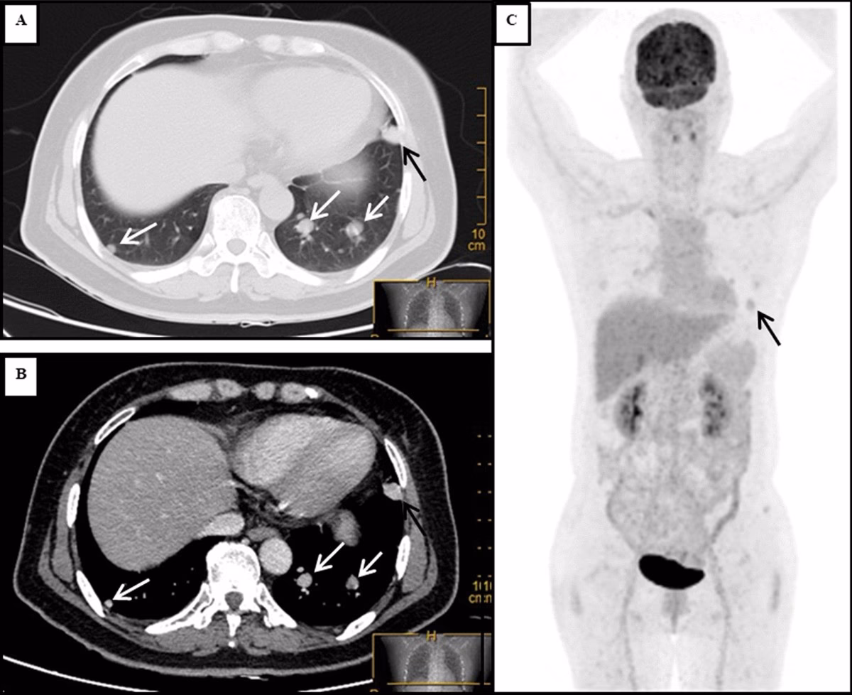 Are thyroid nodules benign or malignant?